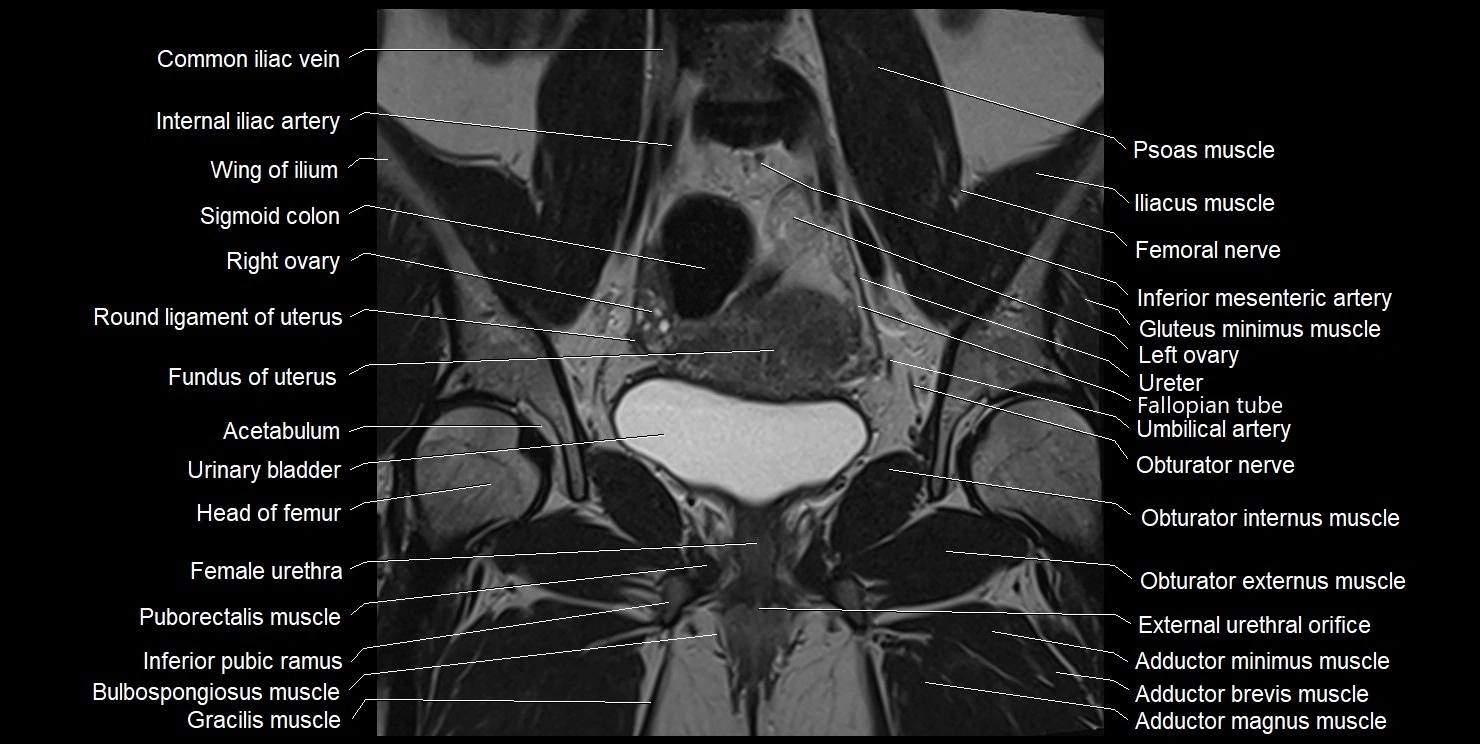 female pelvis coronal cross sectional anatomy image 16.webp